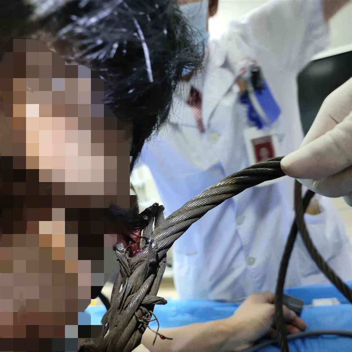  万幸!医生紧急救出左眼钢丝绳