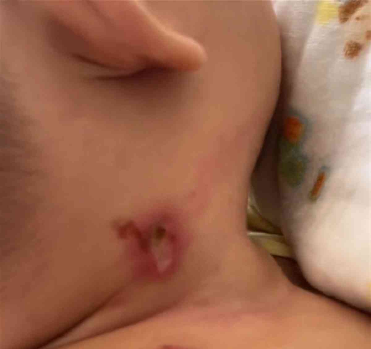 引发社会关注的事件：婴儿被楼上丢的烟头烫伤