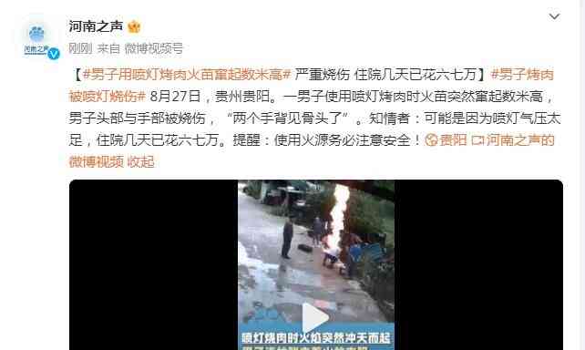 最新焦点新闻 男子烤肉被喷灯严重烧伤