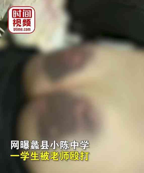  惊爆!学生遭老师殴打,屁股被打成黑紫 形势严峻,待教师问责的时来运转!