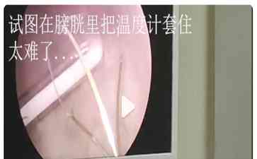 医生，救救我！我膀胱里横着一根温度计！