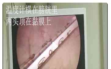 医生，救救我！我膀胱里横着一根温度计！